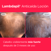 pelo-cabello-caida-capilar-anticaida-crecimiento-alopecia-androgenetica-difusa
