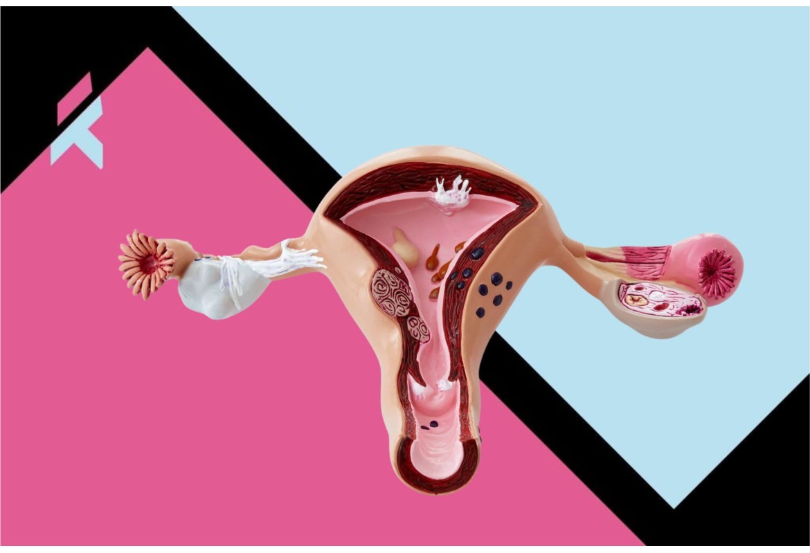 ¿Qué pasa cuando una mujer tiene Síndrome de Ovario Poliquístico (SOP)?