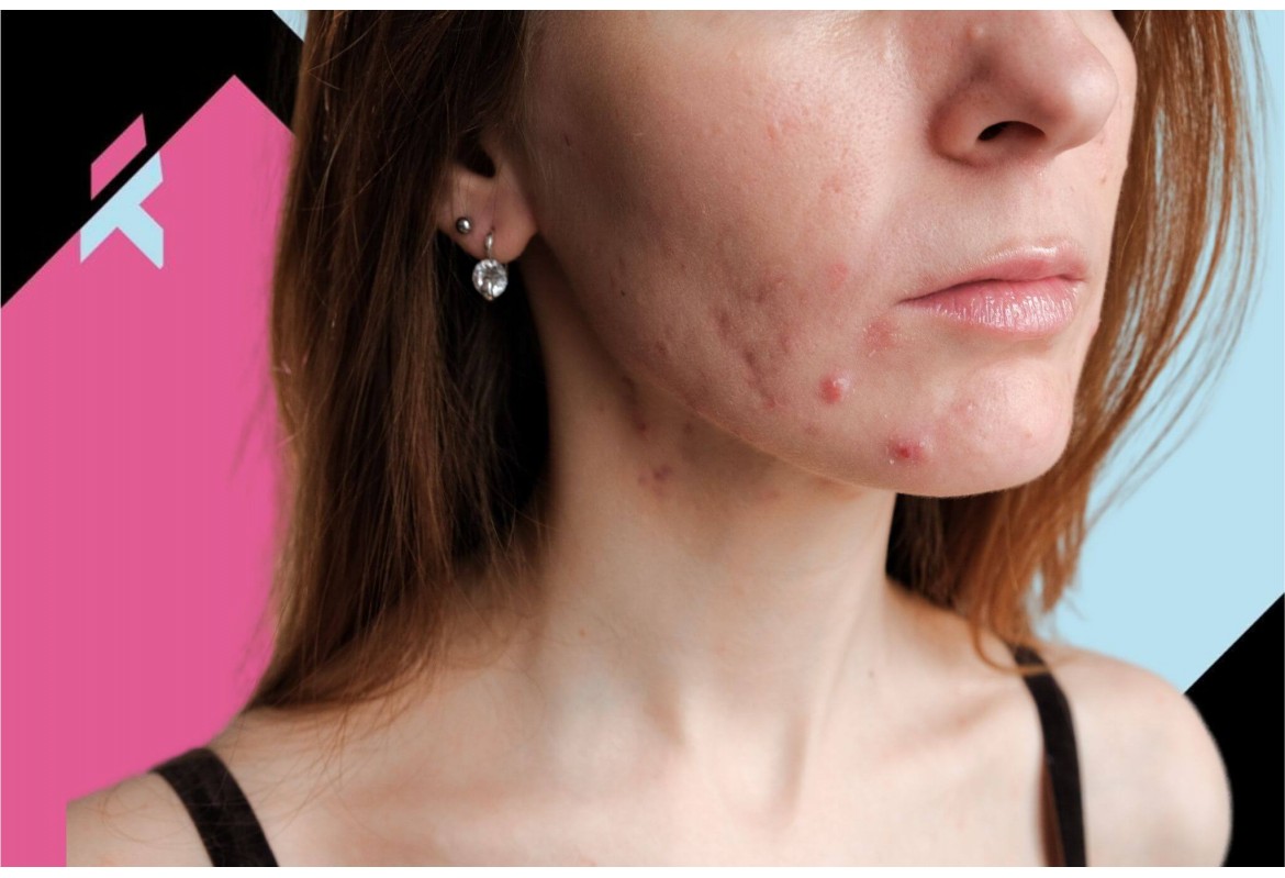 ¿Cómo eliminar el acné ?